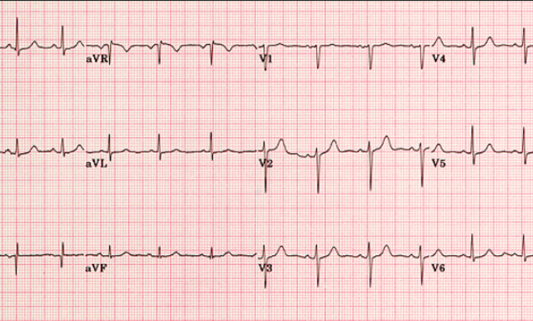 Eletrocardiograma Clínica Particular De Viseu 0102